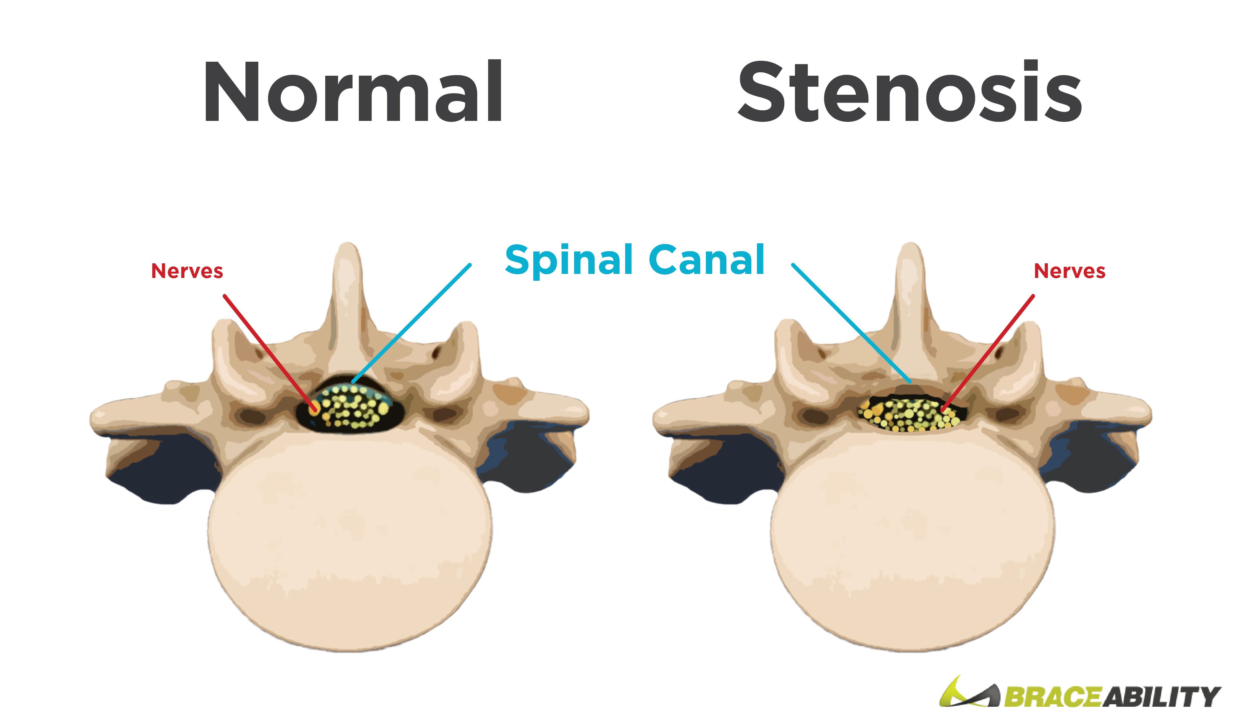 spinal stenosis is caused by the narrowing of the spinal canal