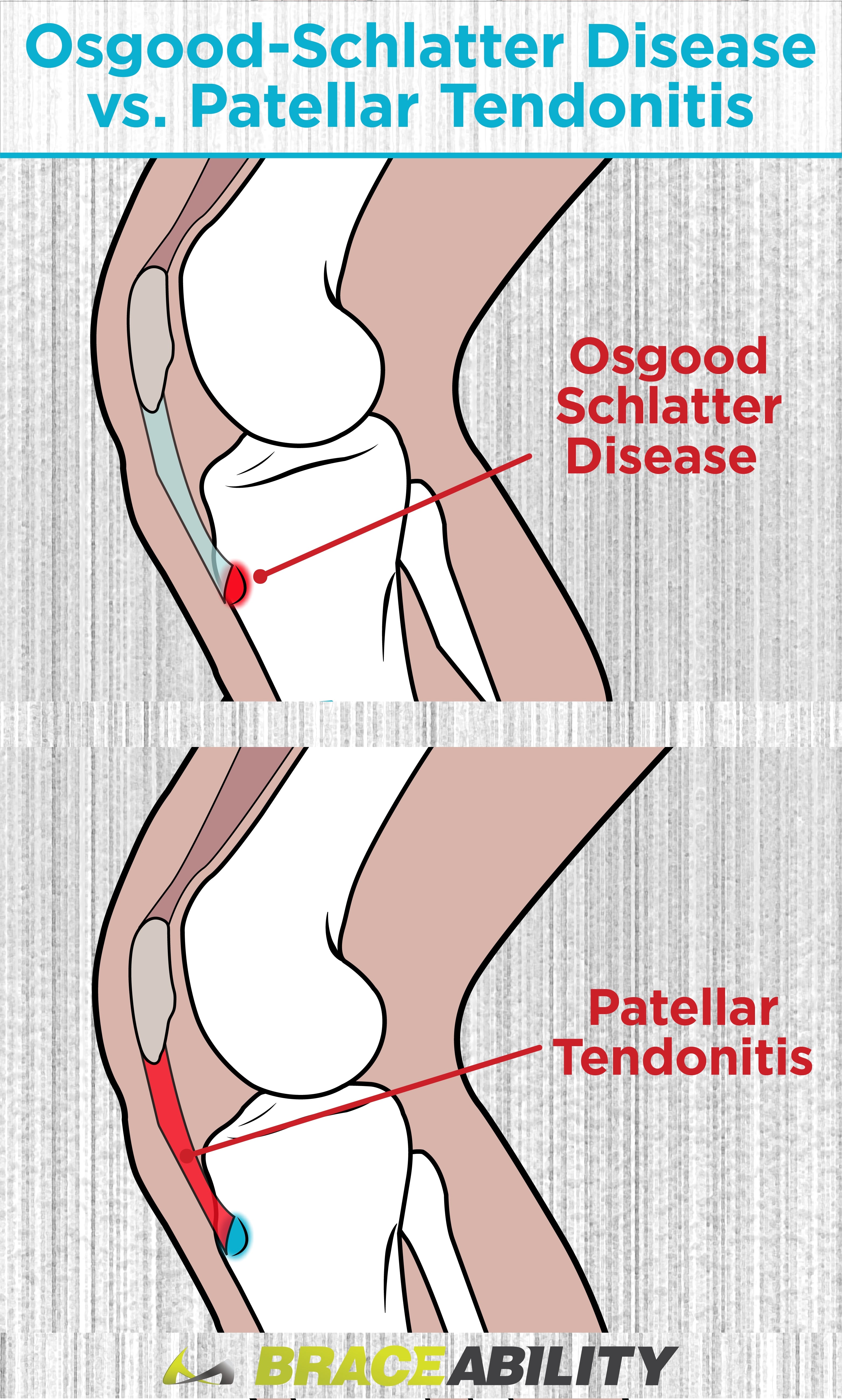 learn about the difference between osgood schlatter disease and patellar tendonitis