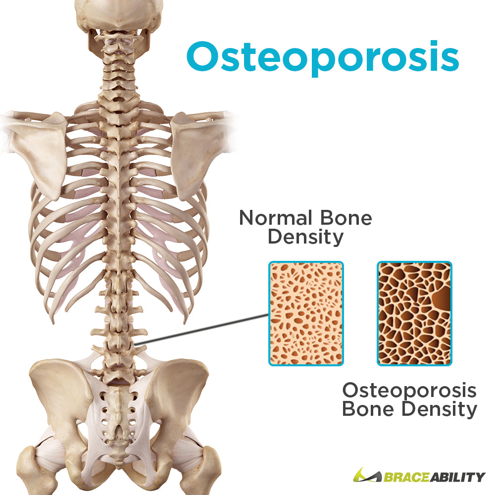 how osteoporosis causes bone density to shrink in your spine