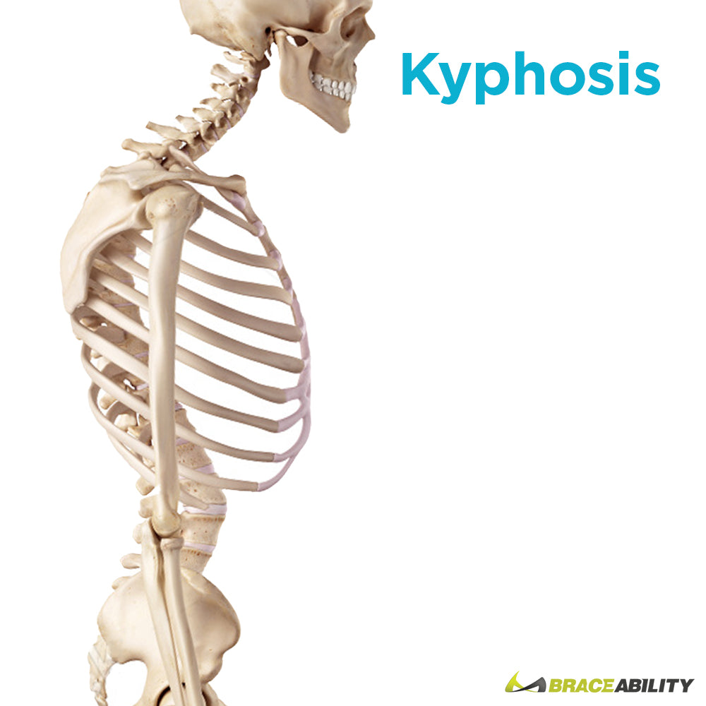 Kyphosis or hunchback from rounded shoulders can be treated with a TLSO back brace