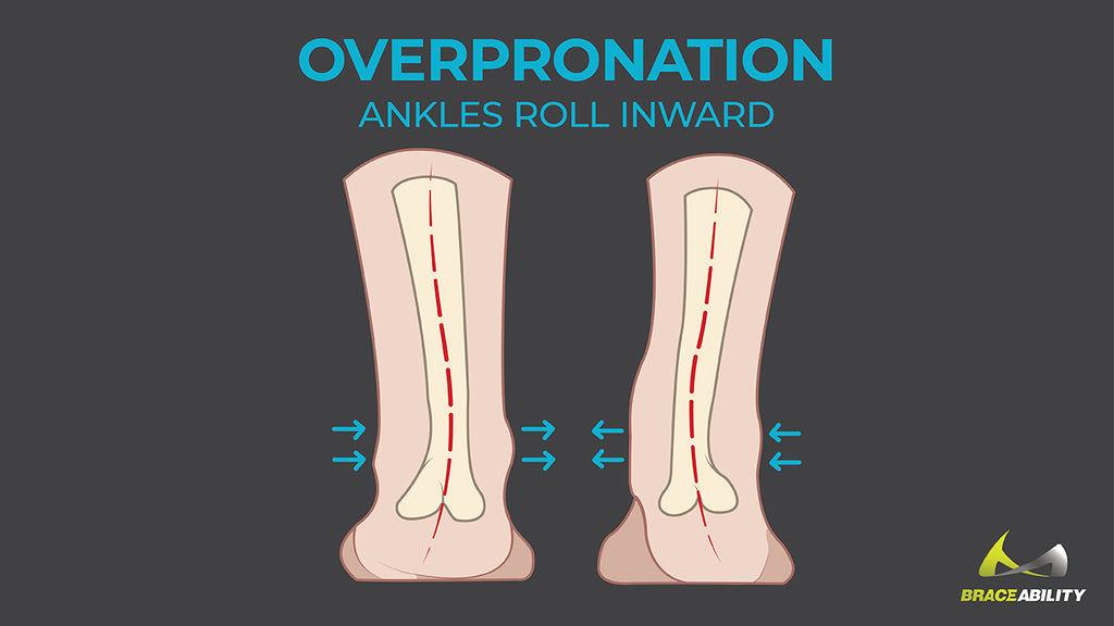 learn about overpronation or the inward rolling of the ankle while running