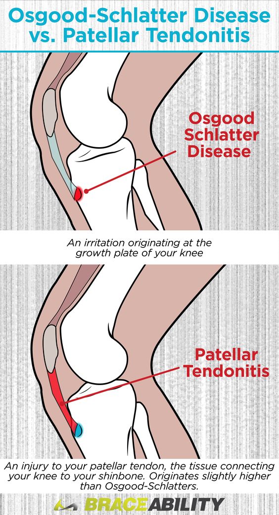 Diagram showing where the patellar tendon is and how to prevent tendonitis compared to osgood-schlatter