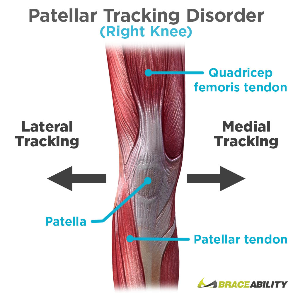medial vs lateral patella tracking disorder causing kneecap pain