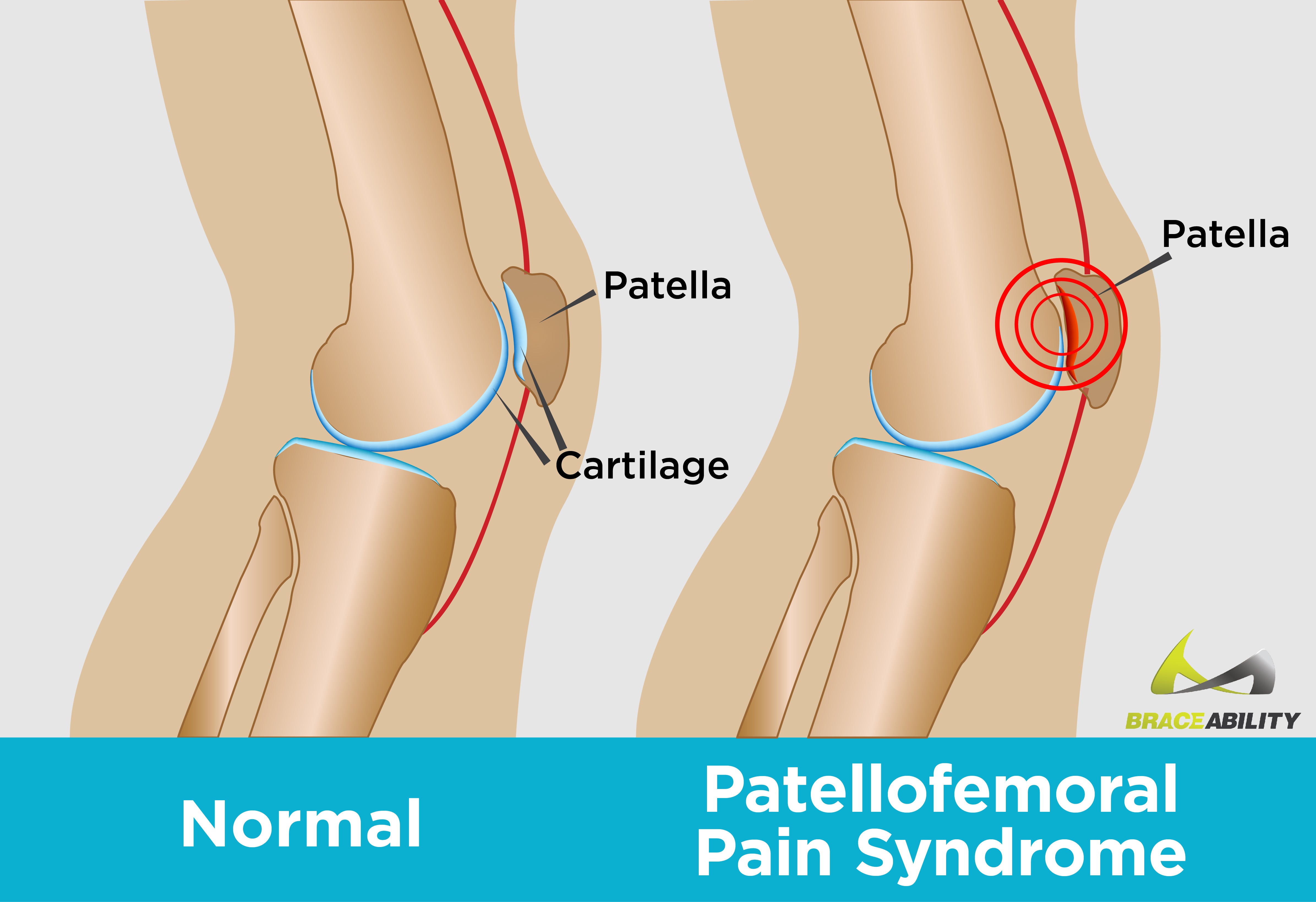 the location of patellofemoral pain above your kneecap