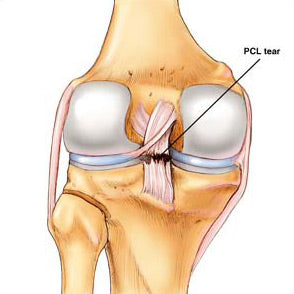 how to diagnose a pcl tear behind you knee