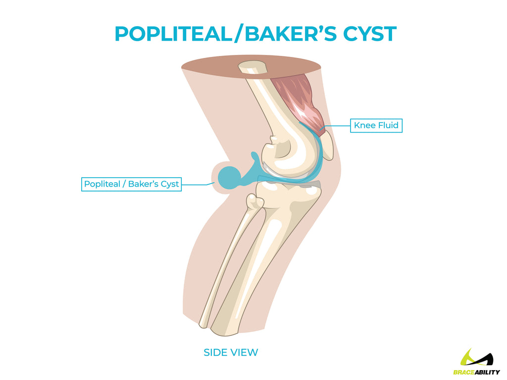 anatomy of a popliteal or baker's cyst in back of the knee