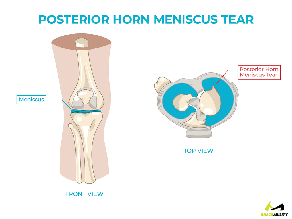 anatomy of a posterior horn meniscus tear causing knee pain