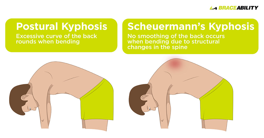 image showing the difference between postural kyphosis and scheuermann's kyphosis