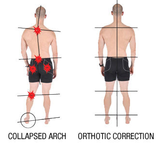 how a collapsed arch can cause running knee pain