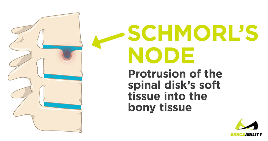 after time Scheuermann's disease can cause schmorl nodes in your spine