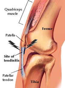 patellar tendonitis happens in the tendon connected to bottom of kneecap