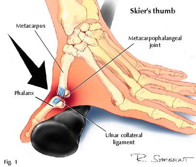 skier's thumb injury hyperabduction of the ulnar collateral ligament 