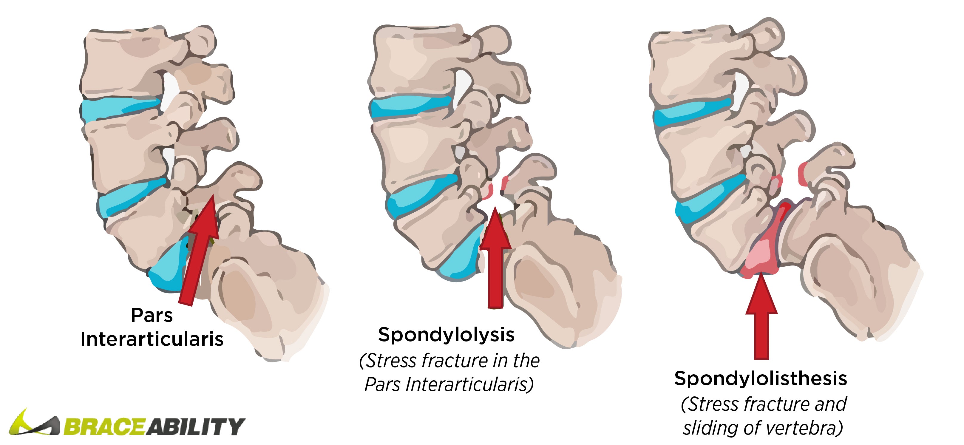 comparison of spondylolysis and spondylolisthesis in the back anatomy