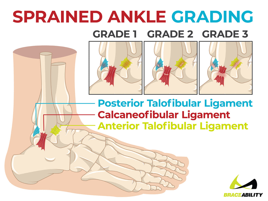 sprained ankle grading and the three grades of injury