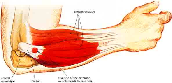 graphic of lateral epicondylitis pain causing tennis elbow in the muscles