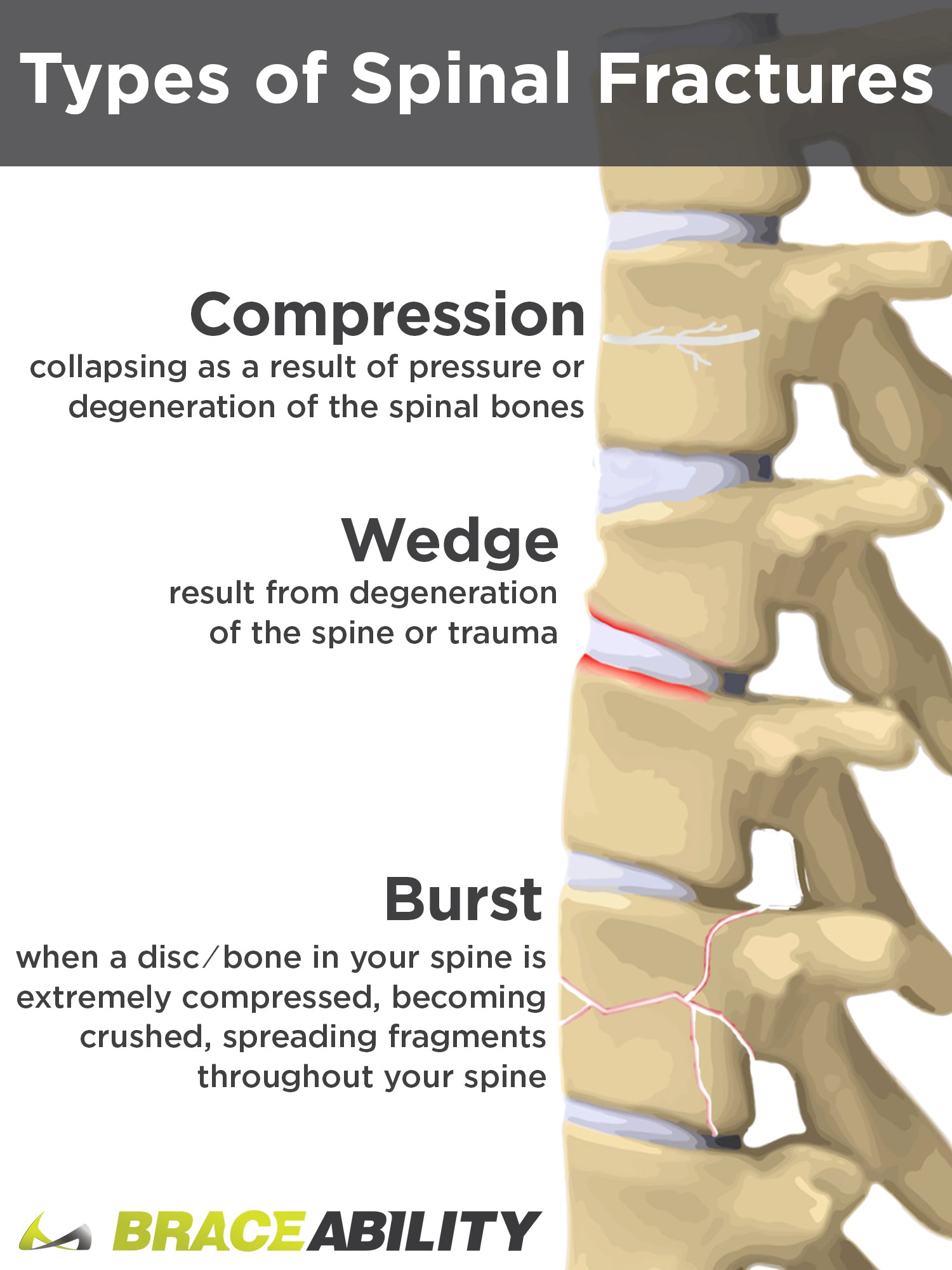 Difference between wedge,compression, & burst spinal fractures