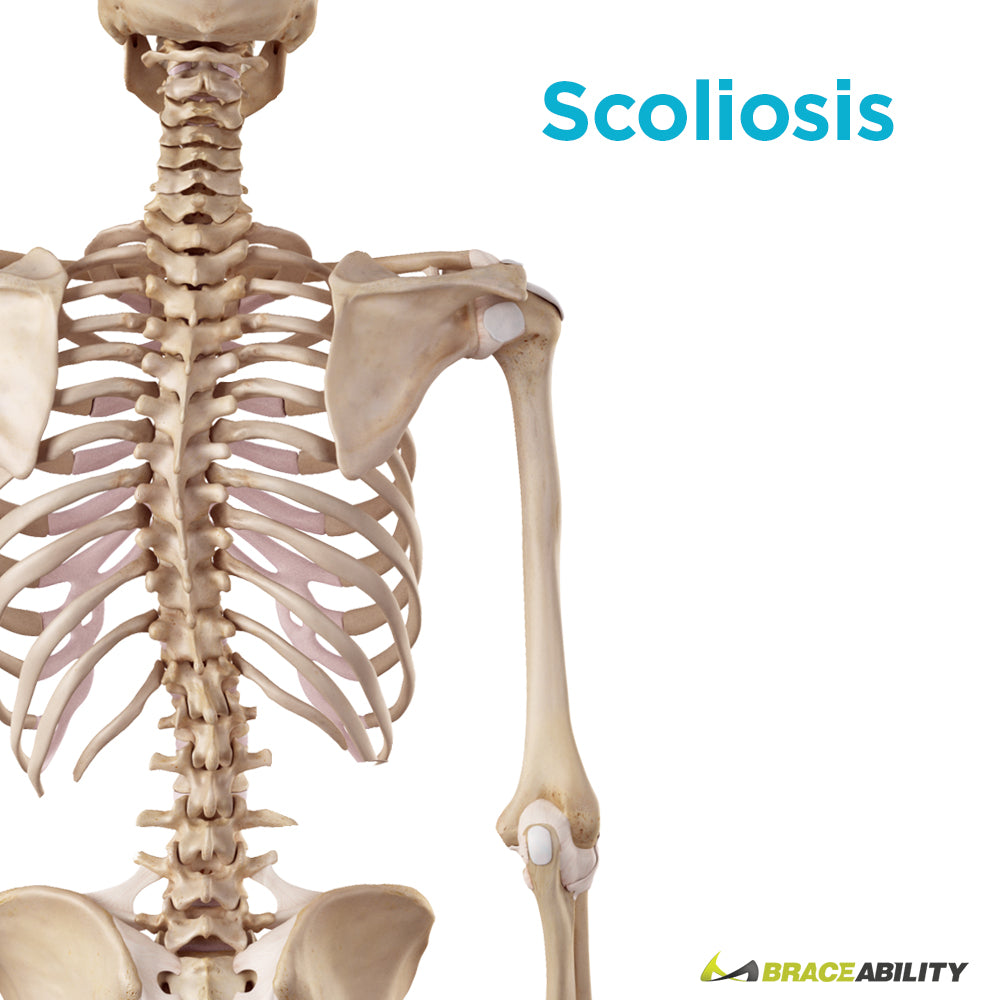You can treat scoliosis or a curved spine with a TLSO back brace