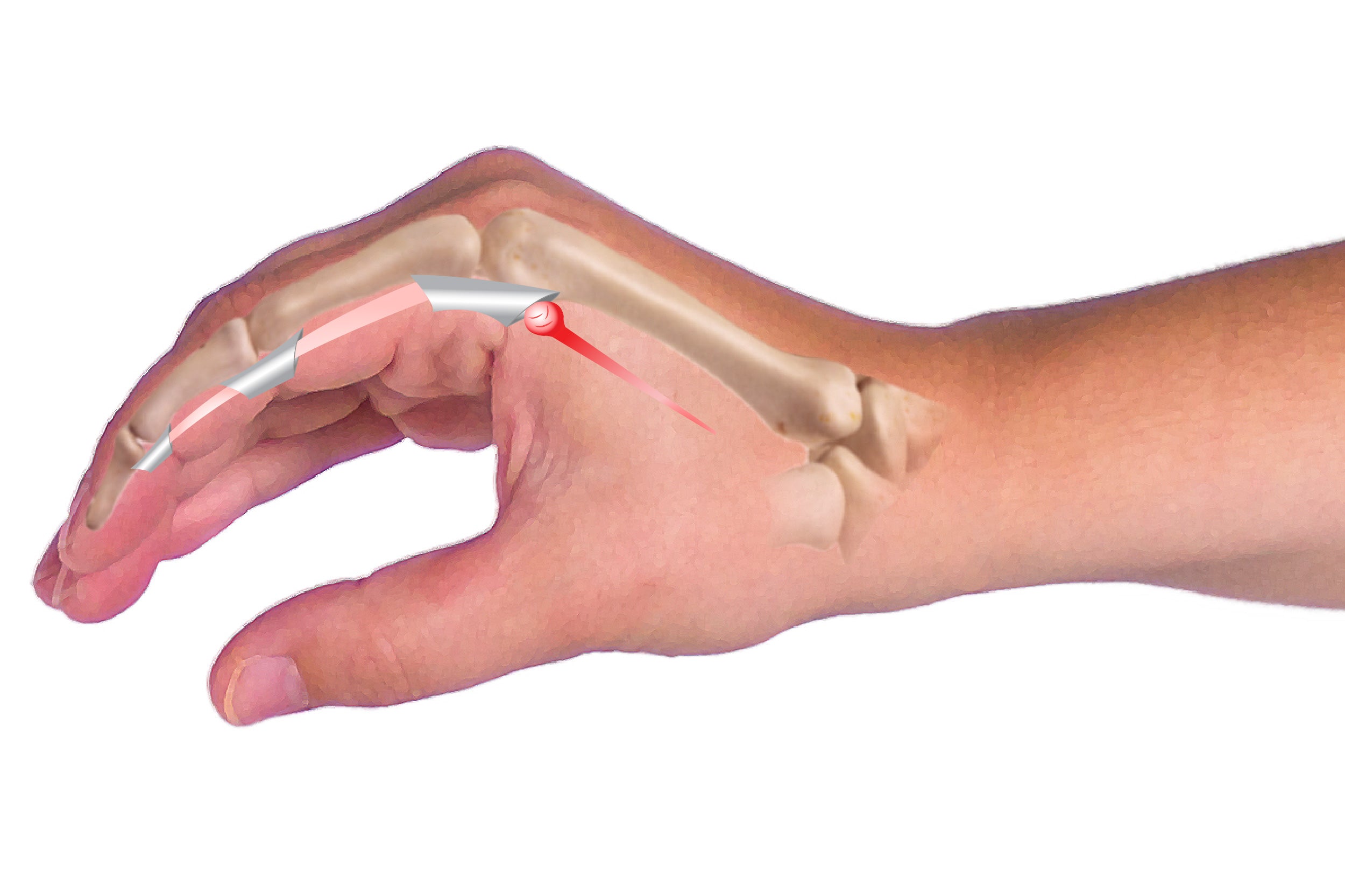 Trigger finger is caused by a tendon being pinched and causing your finger to stay pointed