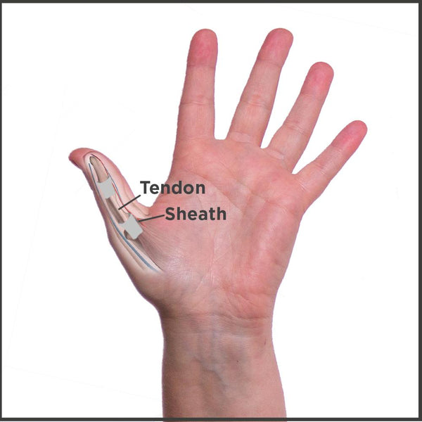 anatomy of trigger thumb condition caused by inflamed tendons