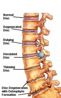 degenerative disc disease can lead to herniated disc or spinal stenosis