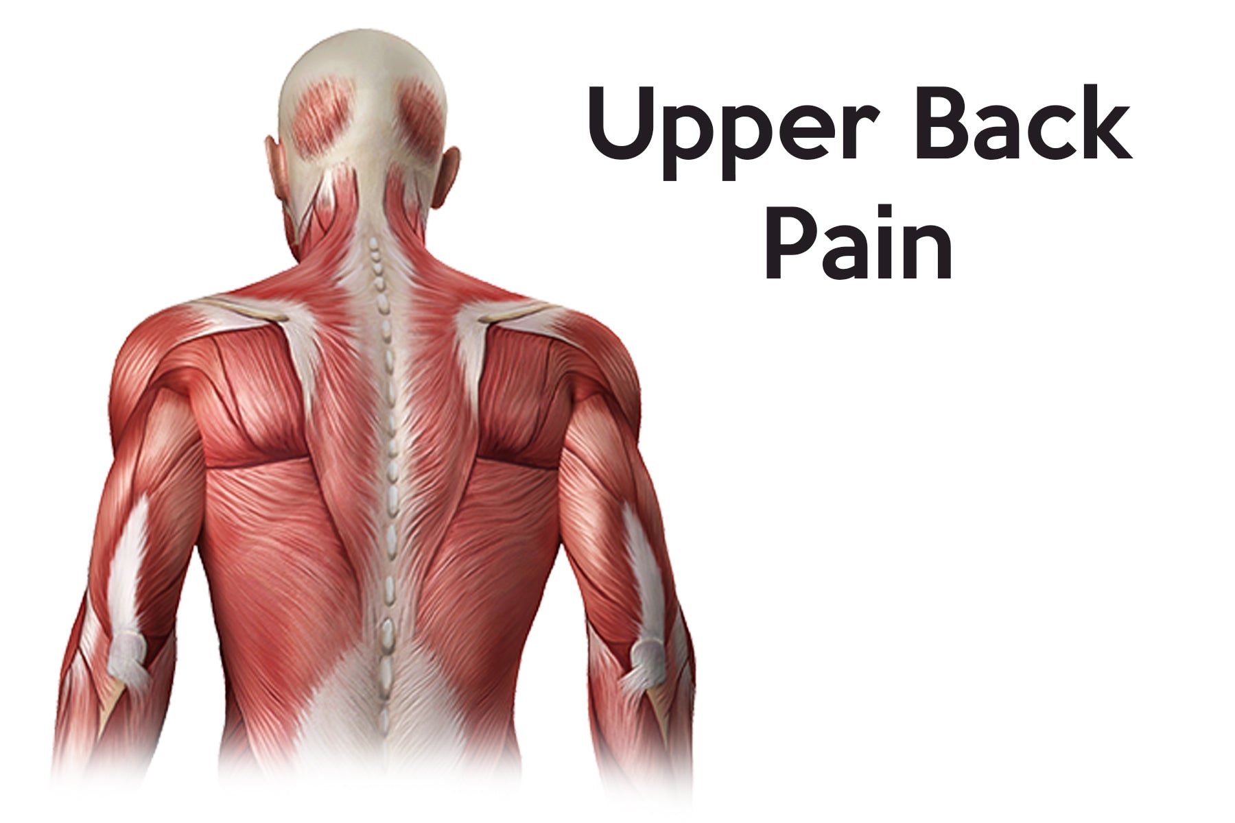 There are many treatment options for upper back pain, use this chart to determine the recovery process you need