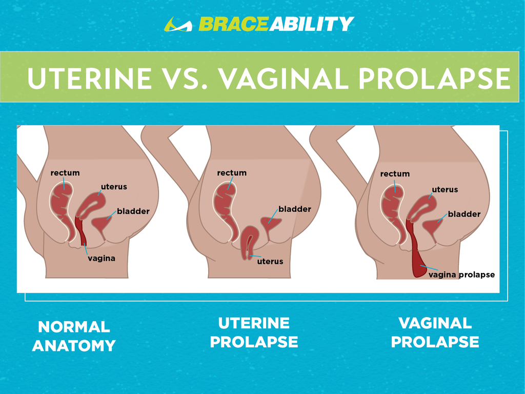 uterine vs vaginal prolapse anatomy