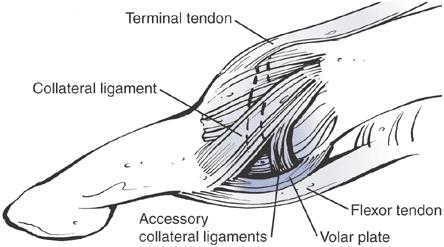 thumb volar plate ligament can be sprained or ruptured due to hyperextension 