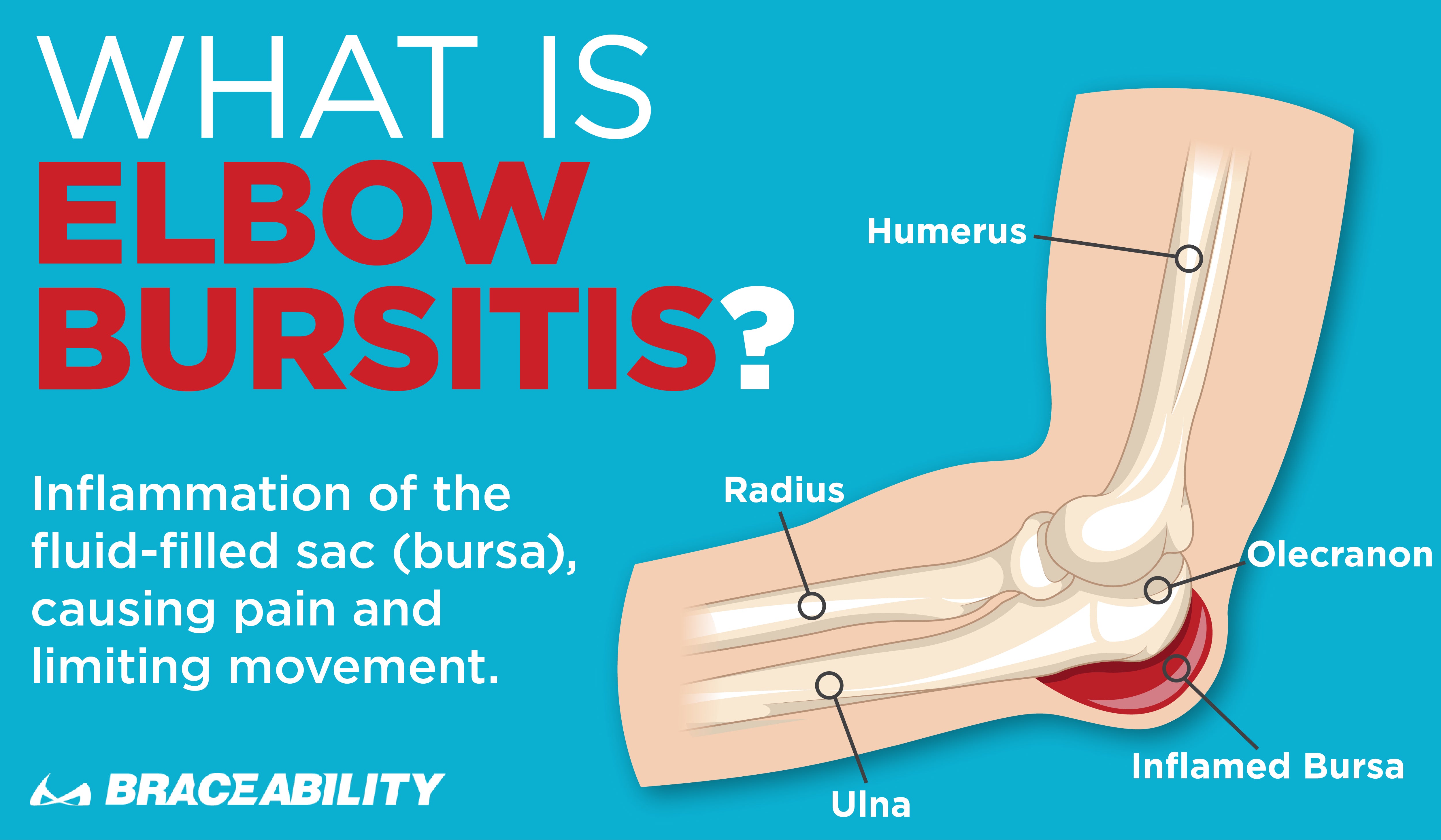elbow bursitis causes a swollen inflammation on the outside of your elbow causing pain when touched