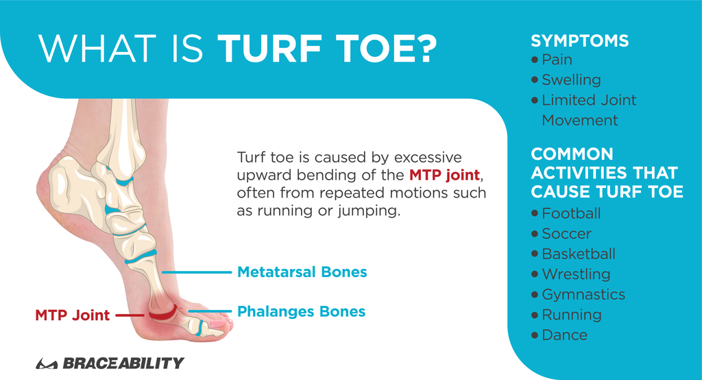 Turf toe is caused by the excessive bending of the big toe, causing pain and swelling in the MTP joint