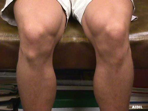 what osgood-schlatters disease looks like on a leg