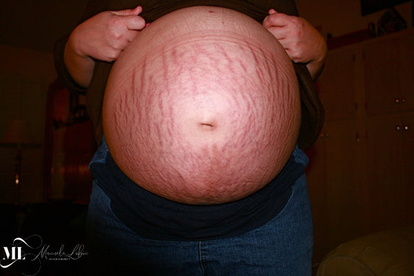 All About Stretch Marks and Your Body