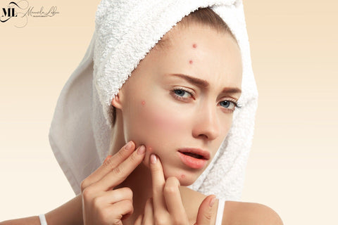 5 Tips To Help You Get Rid Of Acne