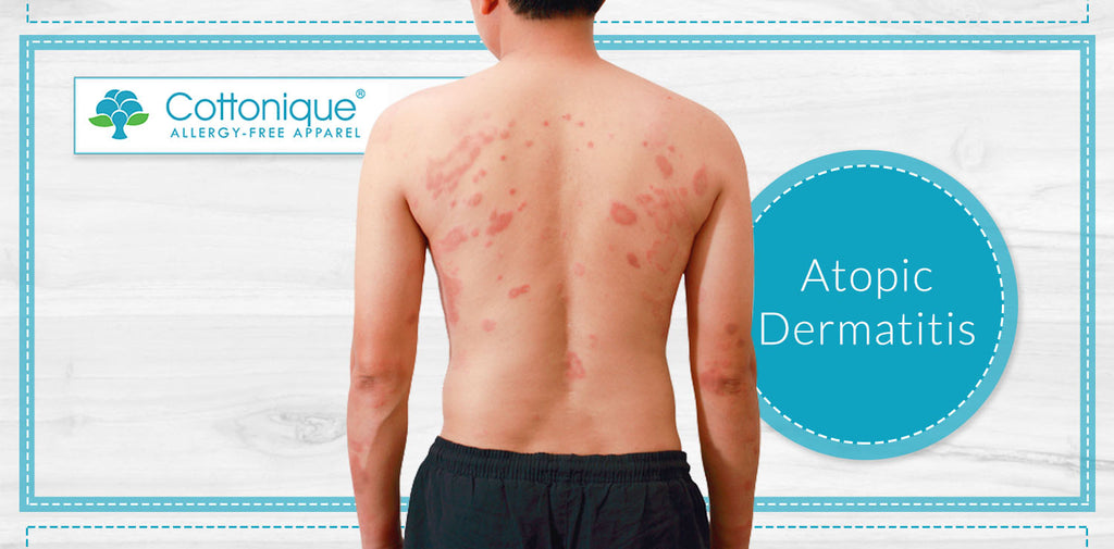 Cottonique - Atopic Dermatitis