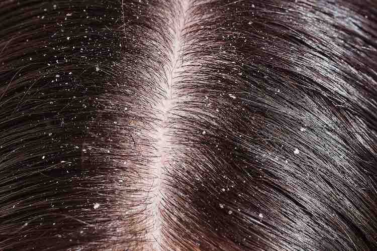 dandruff