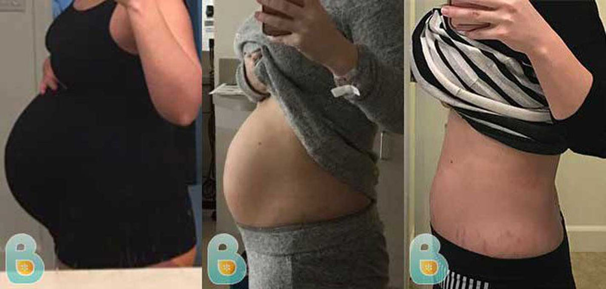 Mom affected with Diastasis Recti avoids reparative surgery and