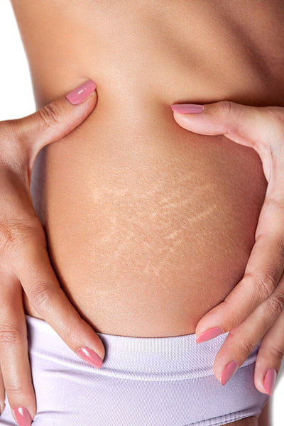 how to get rid of stretch marks fast