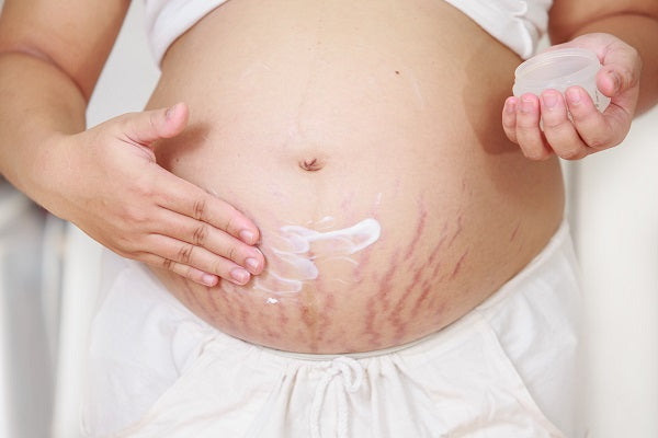 stretch mark cream for pregnancy