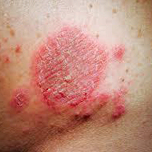 What causes nummular eczema Grahams Natural