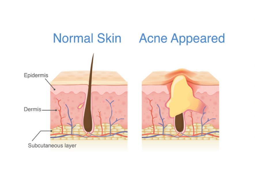 Acne is actually a clogged hair follicle