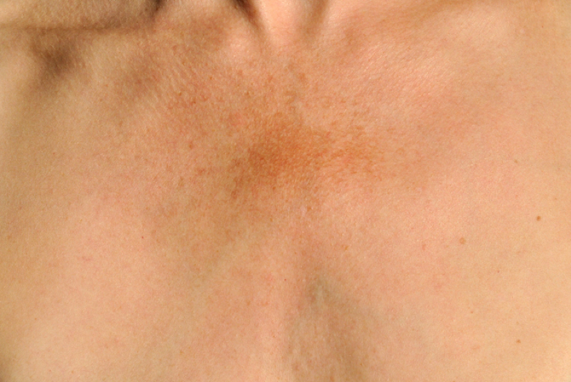 Skin discoloration, what causes it?