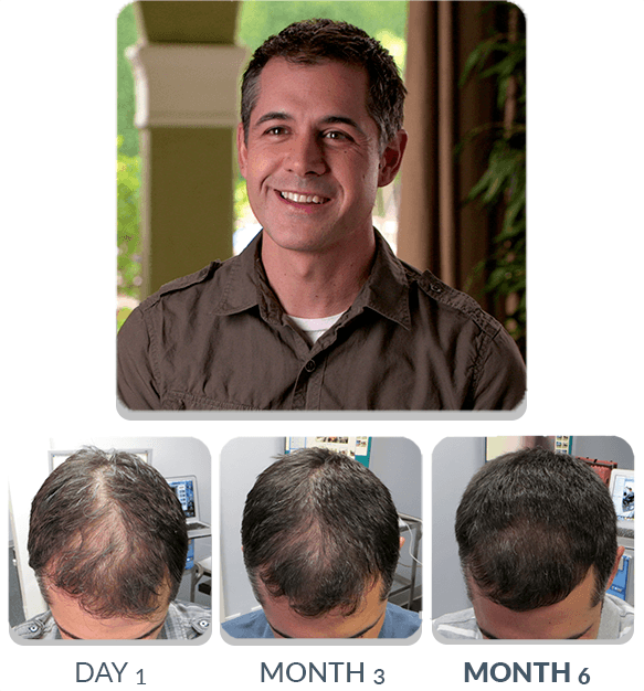 PATENTED HAIR REGROWTH SYSTEM FOR MEN (SPECIAL TV OFFER) | ScalpMED®