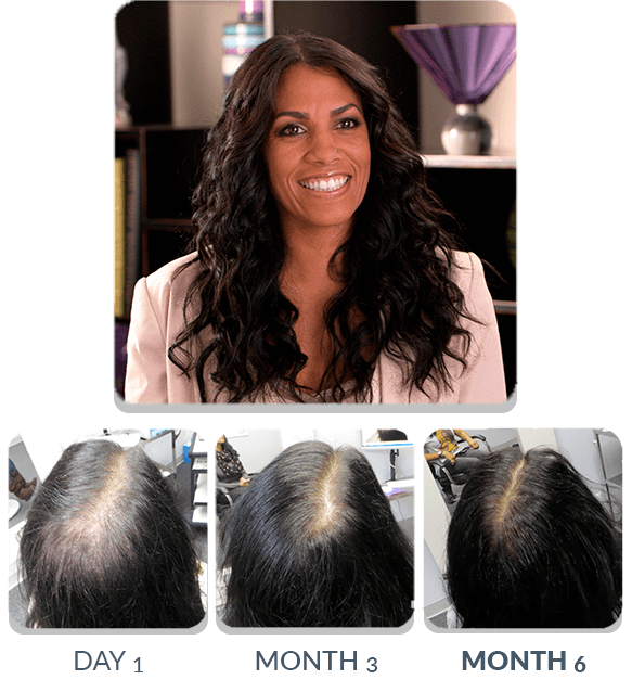 PATENTED HAIR REGROWTH SYSTEM FOR WOMEN | ScalpMED®