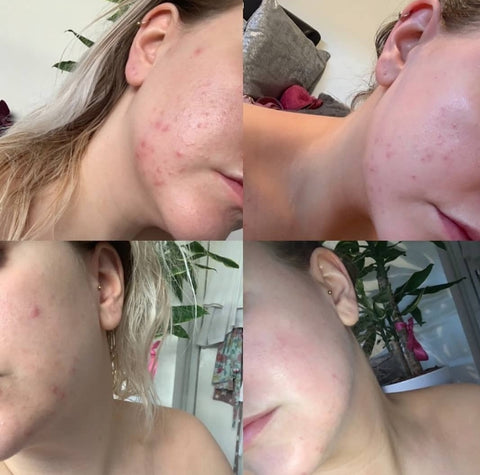 Tasha amazing skin improvements