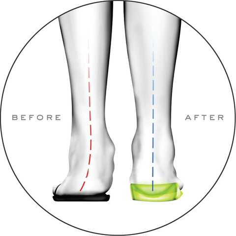 what are orthotic insoles