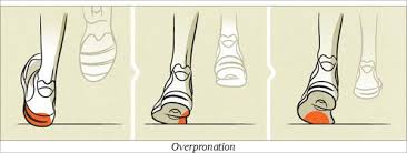 orthotics correct overpronation