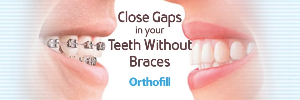 where to get teeth effect bands