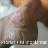psoriasis palmoplantar