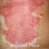 Psoriasis Placa