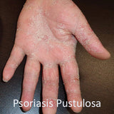 psoriasis pustulosa