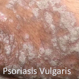 psoriasis vulgaris o comun